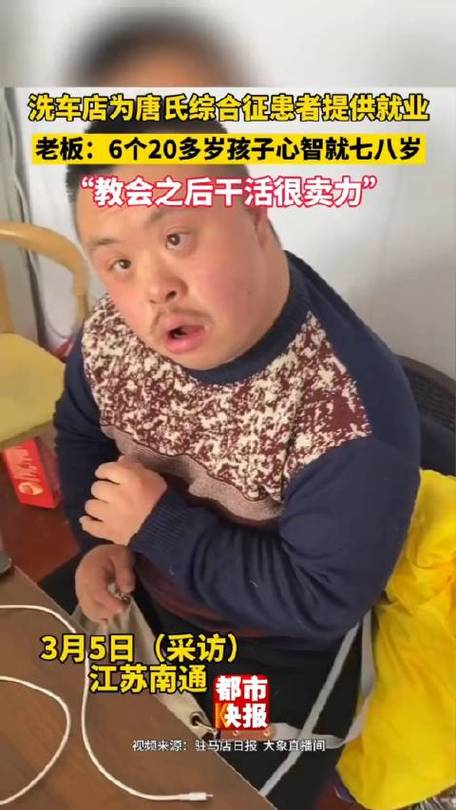 唐氏综合征