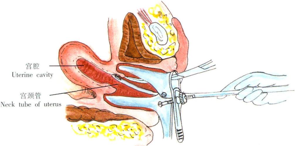 诊刮手术