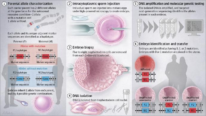  胚胎植入前遗传学诊断