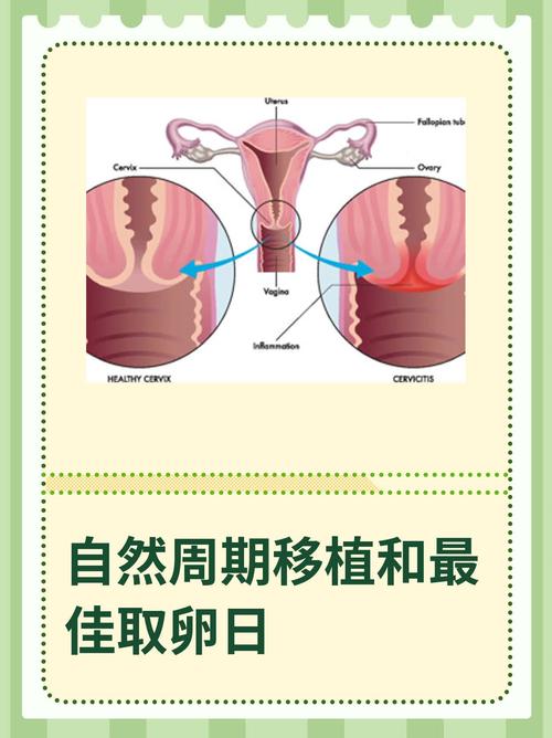 取卵移植