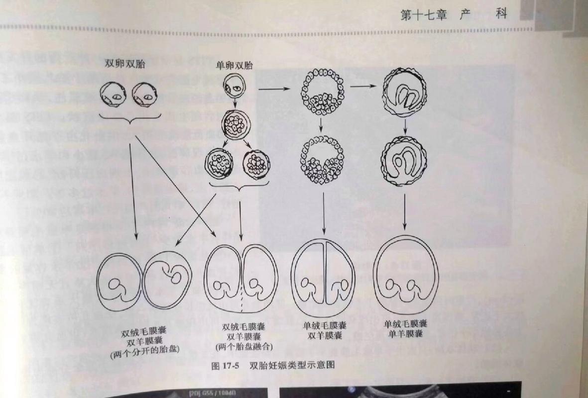  多胎妊娠