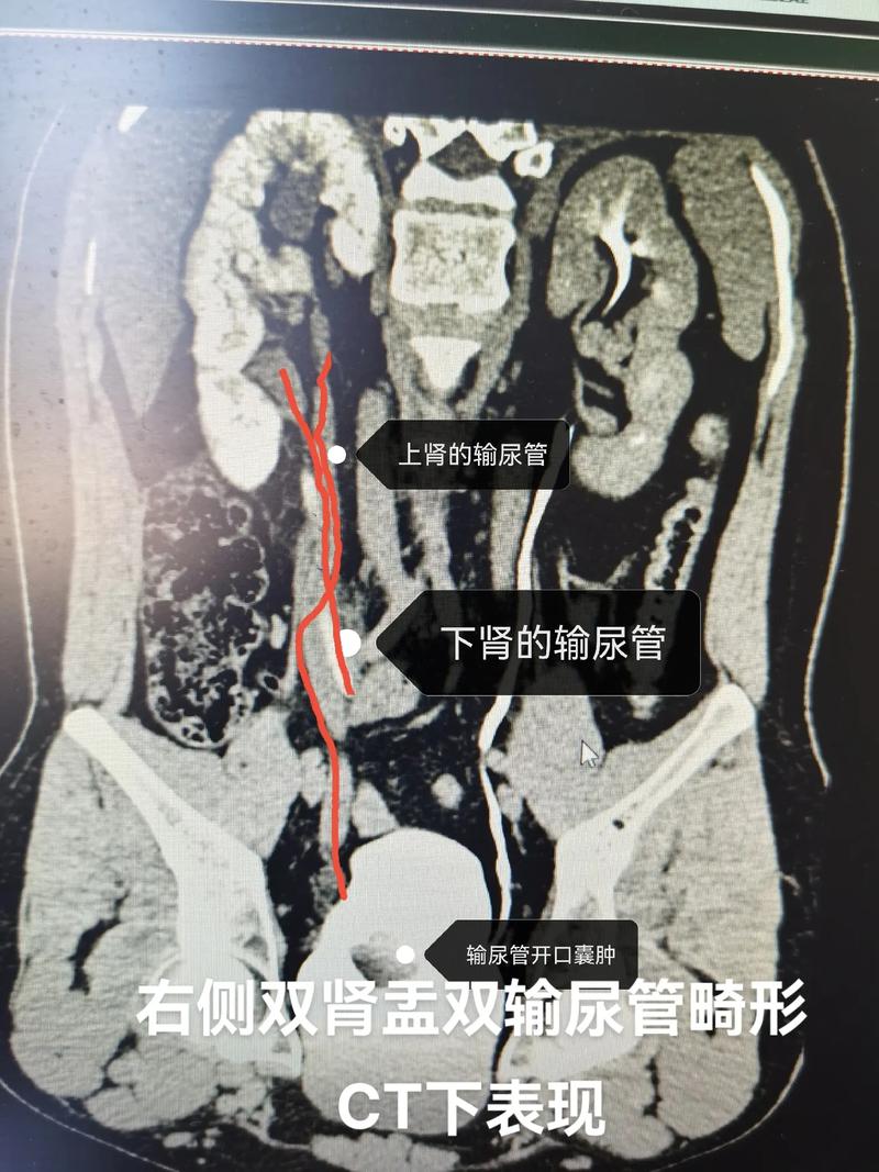  泌尿系统畸形