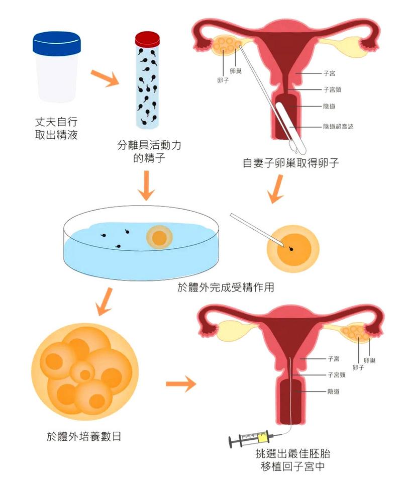 设计试管婴儿