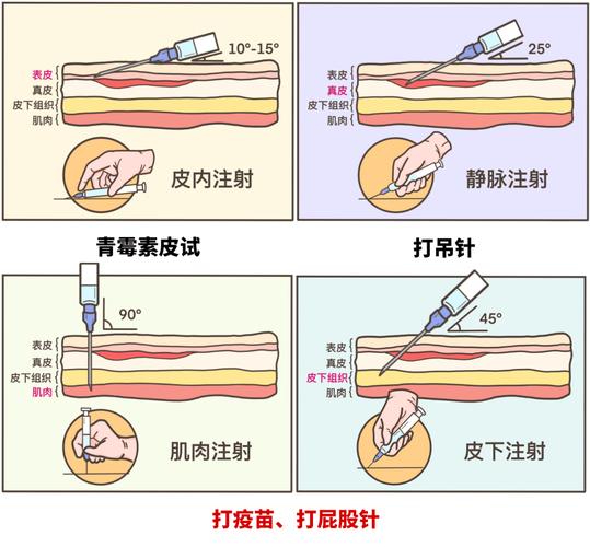 皮下注射