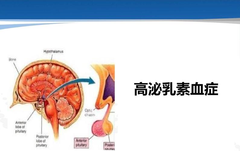 高泌乳素血症