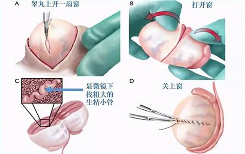 试管婴儿取精过程是否疼痛？