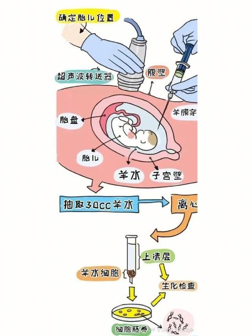 羊水穿刺