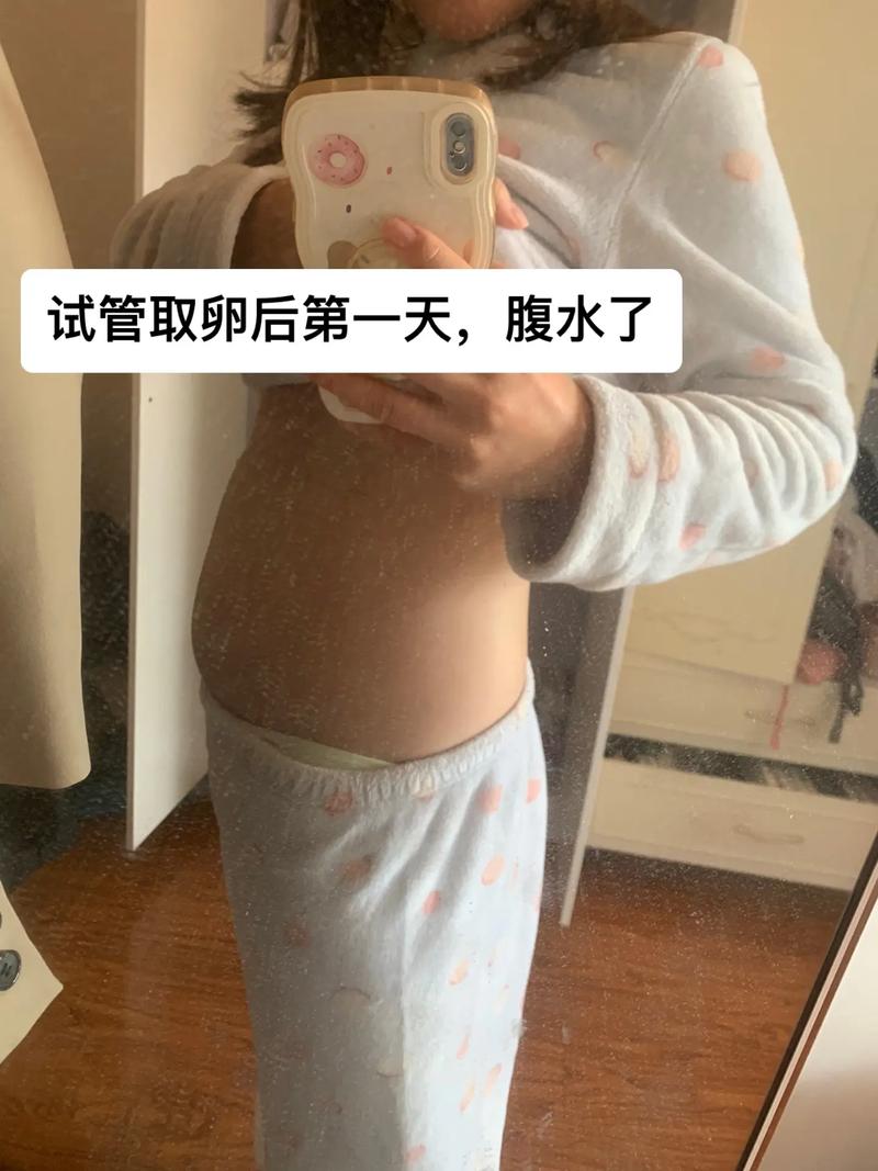 取卵后腹水