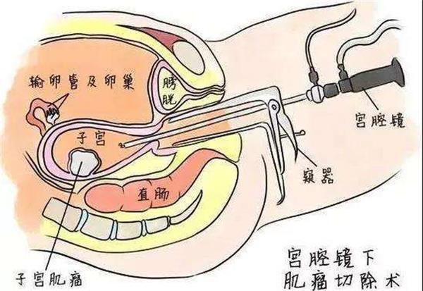 宫腔灌注