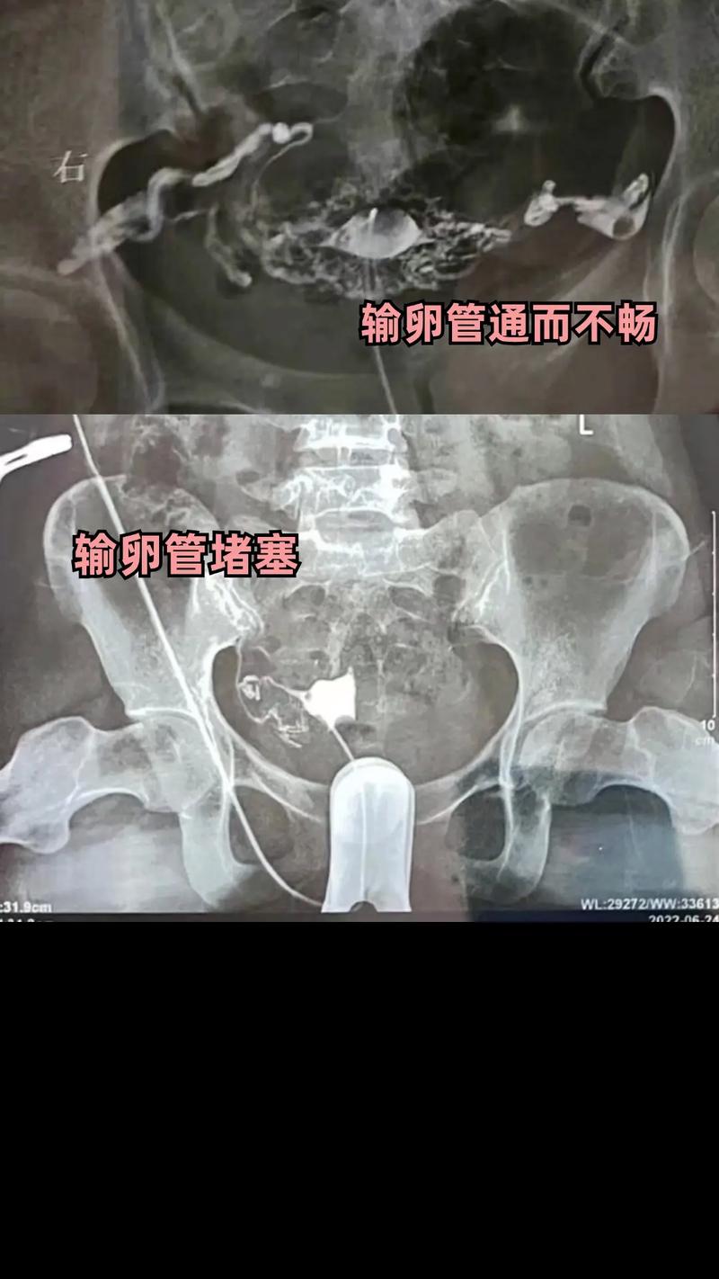  输卵管通畅性