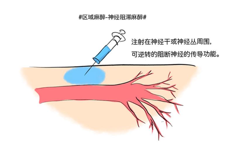 局部麻醉