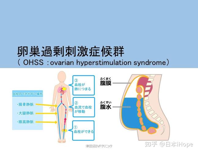  取卵并发症