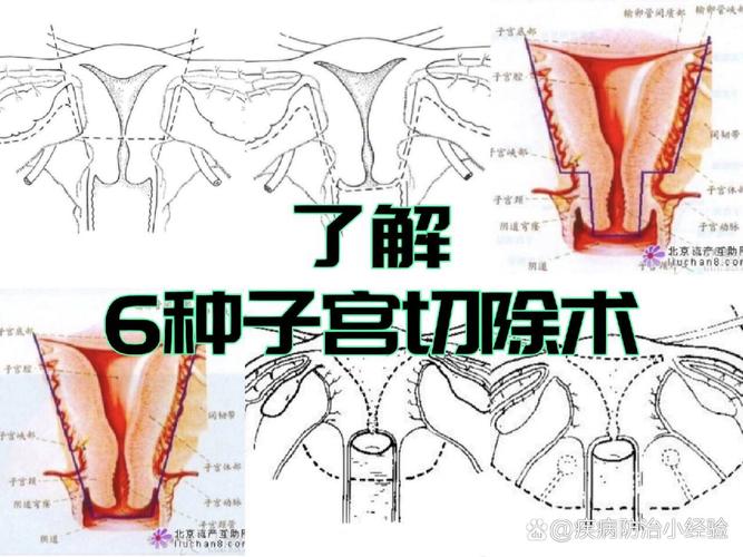 子宫手术史