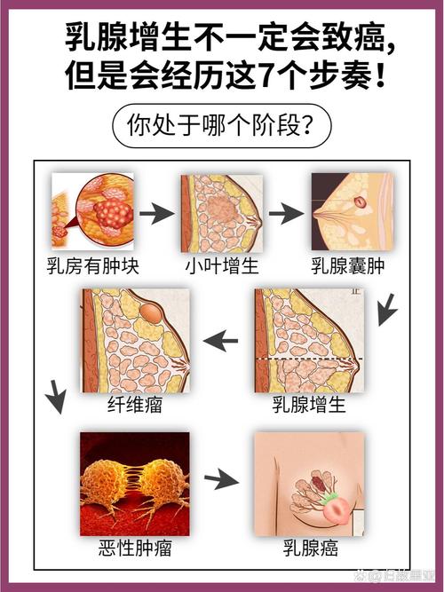  乳腺增生结节