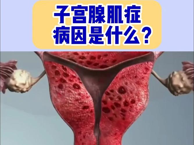 腺肌症