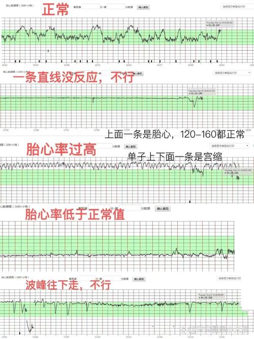 胎心音检测