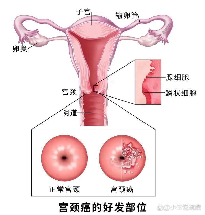 宫颈问题